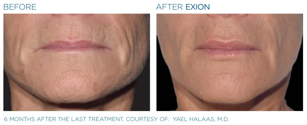 YOUTHFULYOU_EXION_FACE_B&A_EDMONTON_12