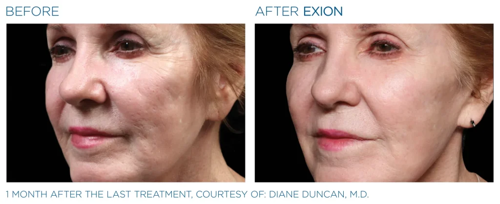 YOUTHFULYOU_EXION_FACE_B&A_EDMONTON_2