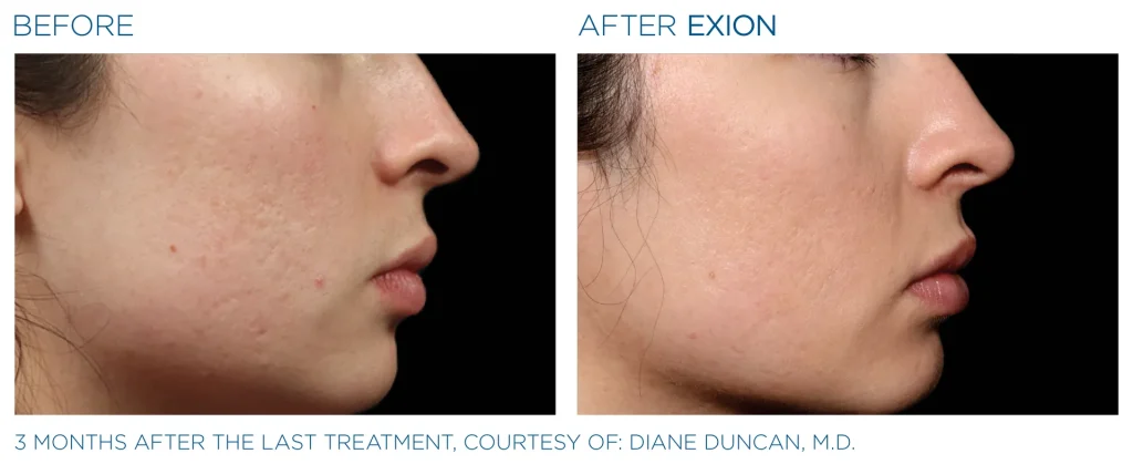YOUTHFULYOU_EXION_FACE_B&A_EDMONTON_3