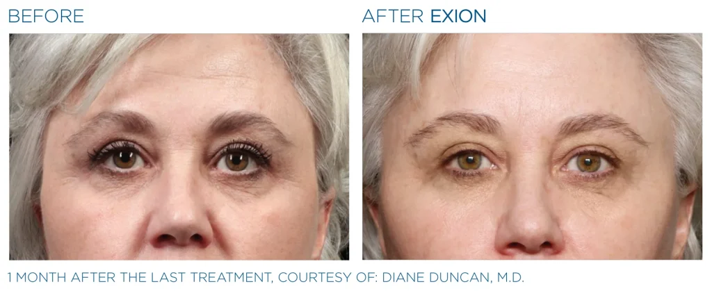 YOUTHFULYOU_EXION_FACE_B&A_EDMONTON_5