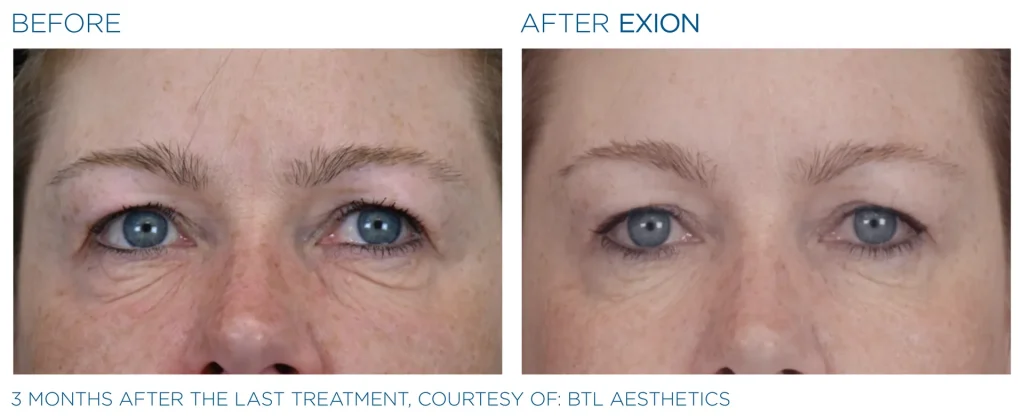 YOUTHFULYOU_EXION_FACE_B&A_EDMONTON_6