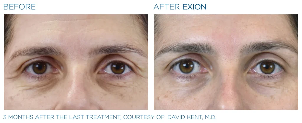YOUTHFULYOU_EXION_FACE_B&A_EDMONTON_7