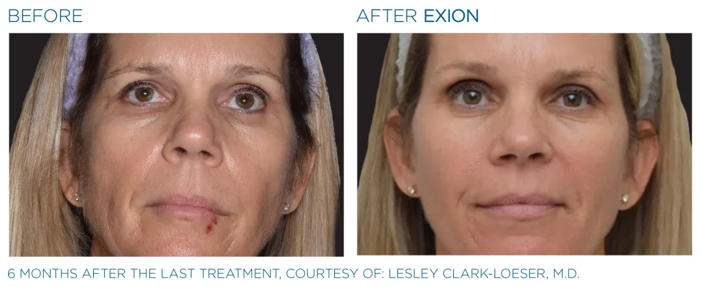 YOUTHFULYOU_EXION_FACE_B&A_EDMONTON_8