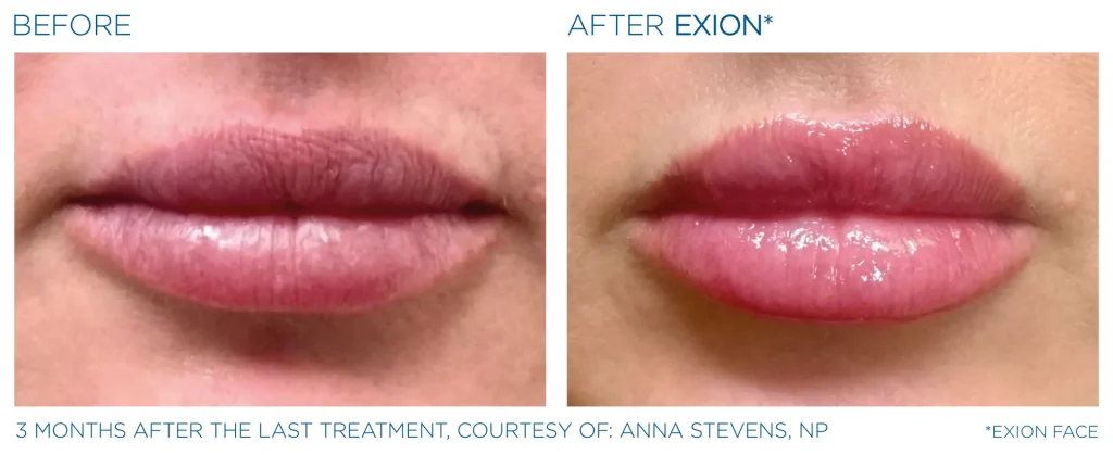 YOUTHFULYOU_EXION_FACE_B&A_EDMONTON_9