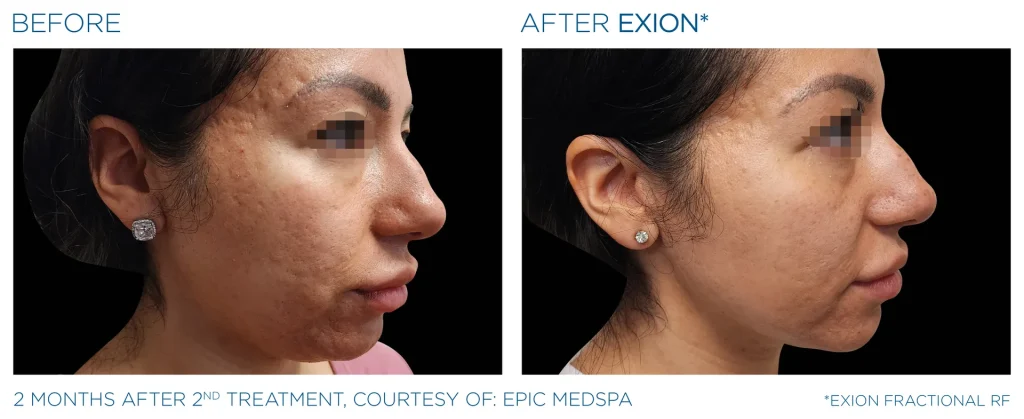 YOUTHFULYOU_EXION_FRACTIONAL_B&A_EDMONTON_1