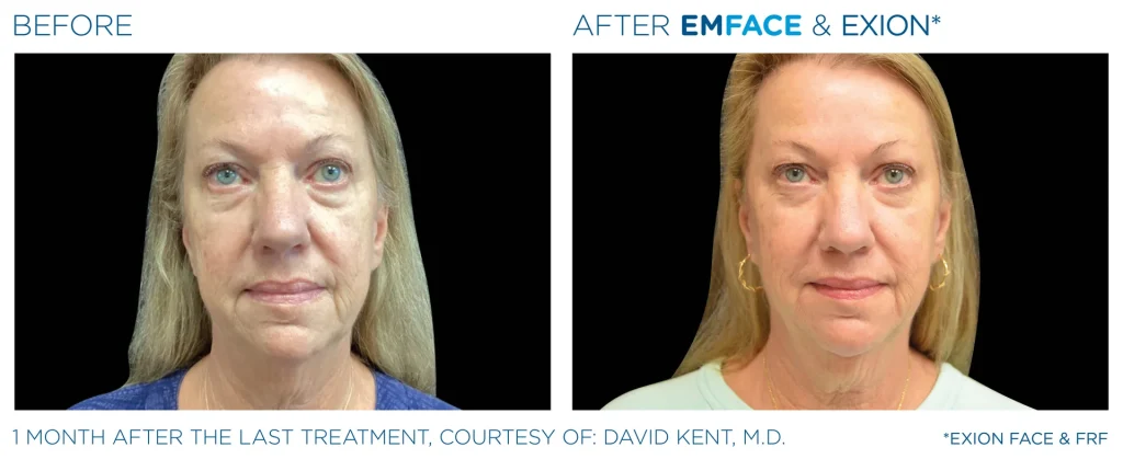 YOUTHFULYOU_EXION_FRACTIONAL_B&A_EDMONTON_2