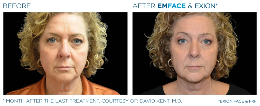 YOUTHFULYOU_EXION_FRACTIONAL_B&A_EDMONTON_3