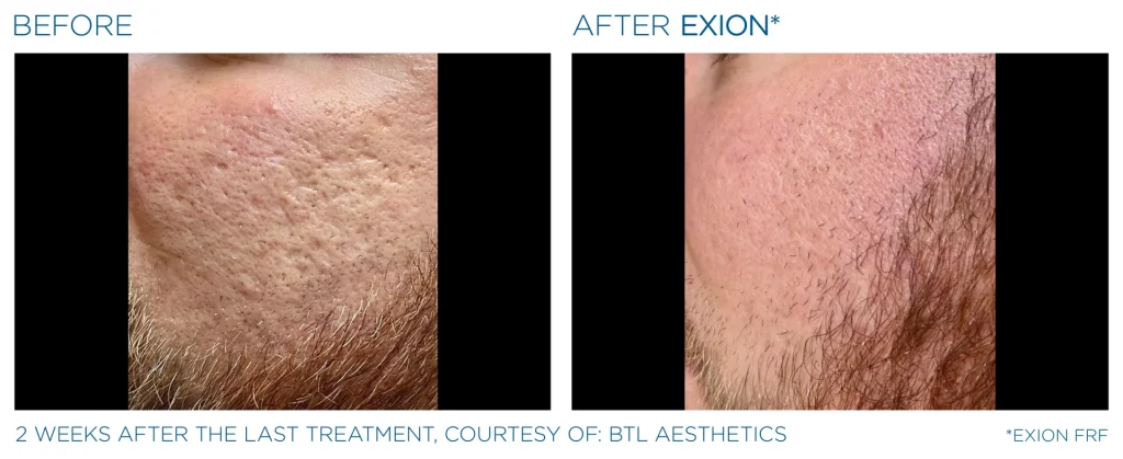 YOUTHFULYOU_EXION_FRACTIONAL_B&A_EDMONTON_6