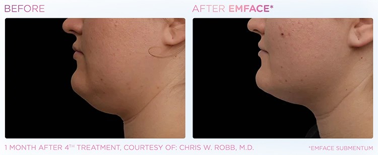 YOUTHFUL_YOU_EMFACE_DOUBLE_CHIN_EDMONTON_11