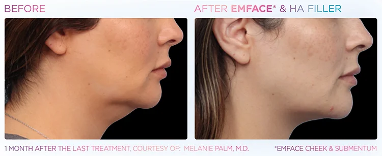 YOUTHFUL_YOU_EMFACE_DOUBLE_CHIN_EDMONTON_15