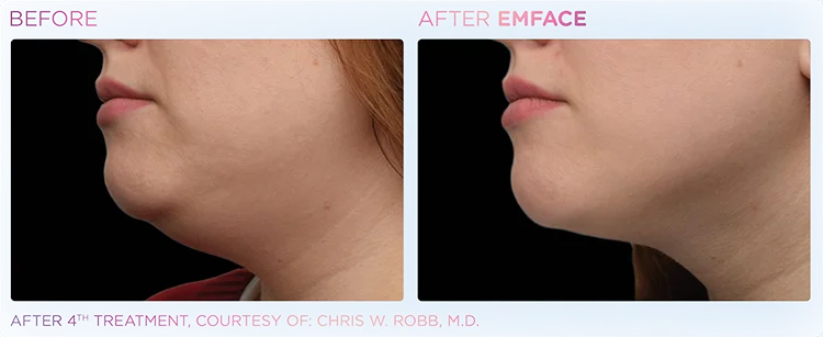 YOUTHFUL_YOU_EMFACE_DOUBLE_CHIN_EDMONTON_2