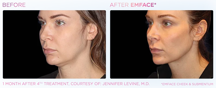 YOUTHFUL_YOU_EMFACE_DOUBLE_CHIN_EDMONTON_4