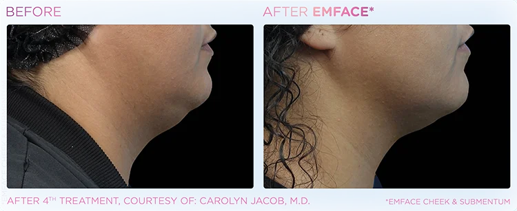 YOUTHFUL_YOU_EMFACE_DOUBLE_CHIN_EDMONTON_5