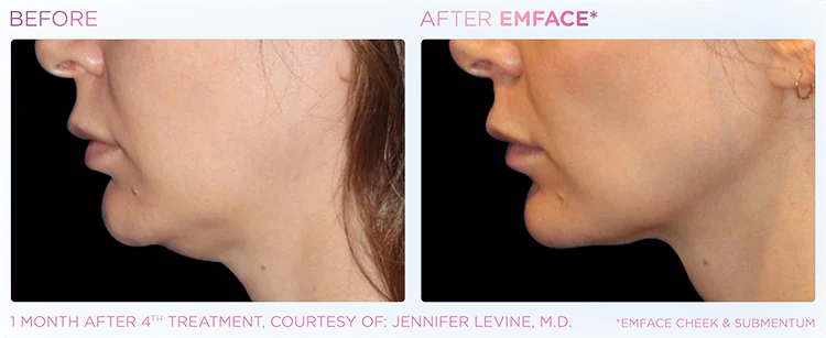 YOUTHFUL_YOU_EMFACE_DOUBLE_CHIN_EDMONTON_6