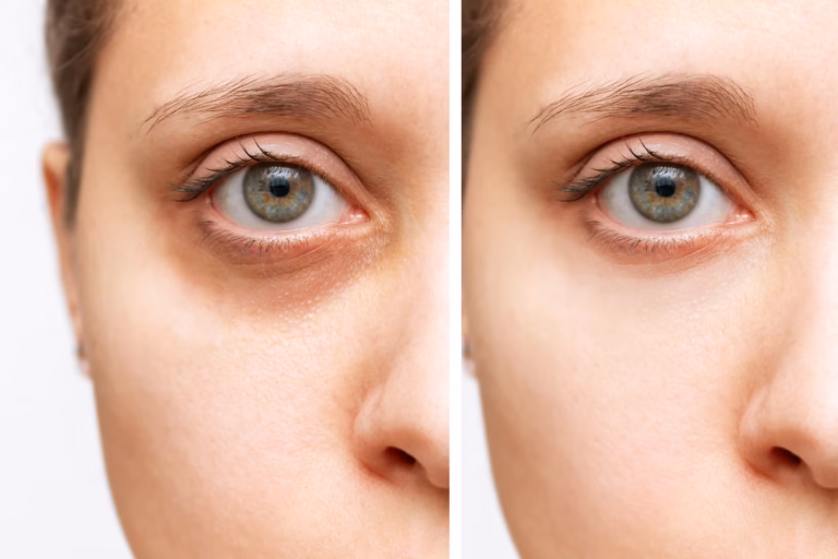 Targeting Dark Circles: PRP vs. Fillers for Under-Eye Rejuvenation